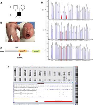 Three Variants Affecting Exon 1 of Ectodysplasin A Cause X-Linked Hypohidrotic Ectodermal Dysplasia: Clinical and Molecular Characteristics